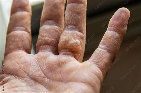 dyshidrotic eczema on black skin|pictures of pompholyx eczema.